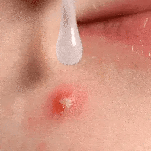 gif espinha gel ai.webp__PID:d1914be9-1111-4e85-b4cf-4a8e0cd6be3d